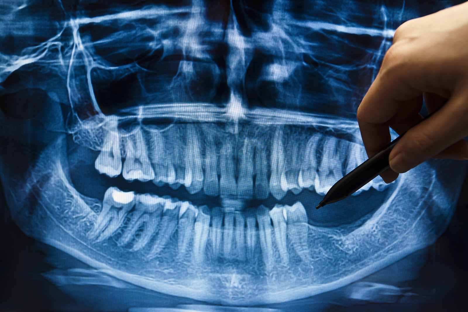 X-Ray beim Zahnarzt in Eppan