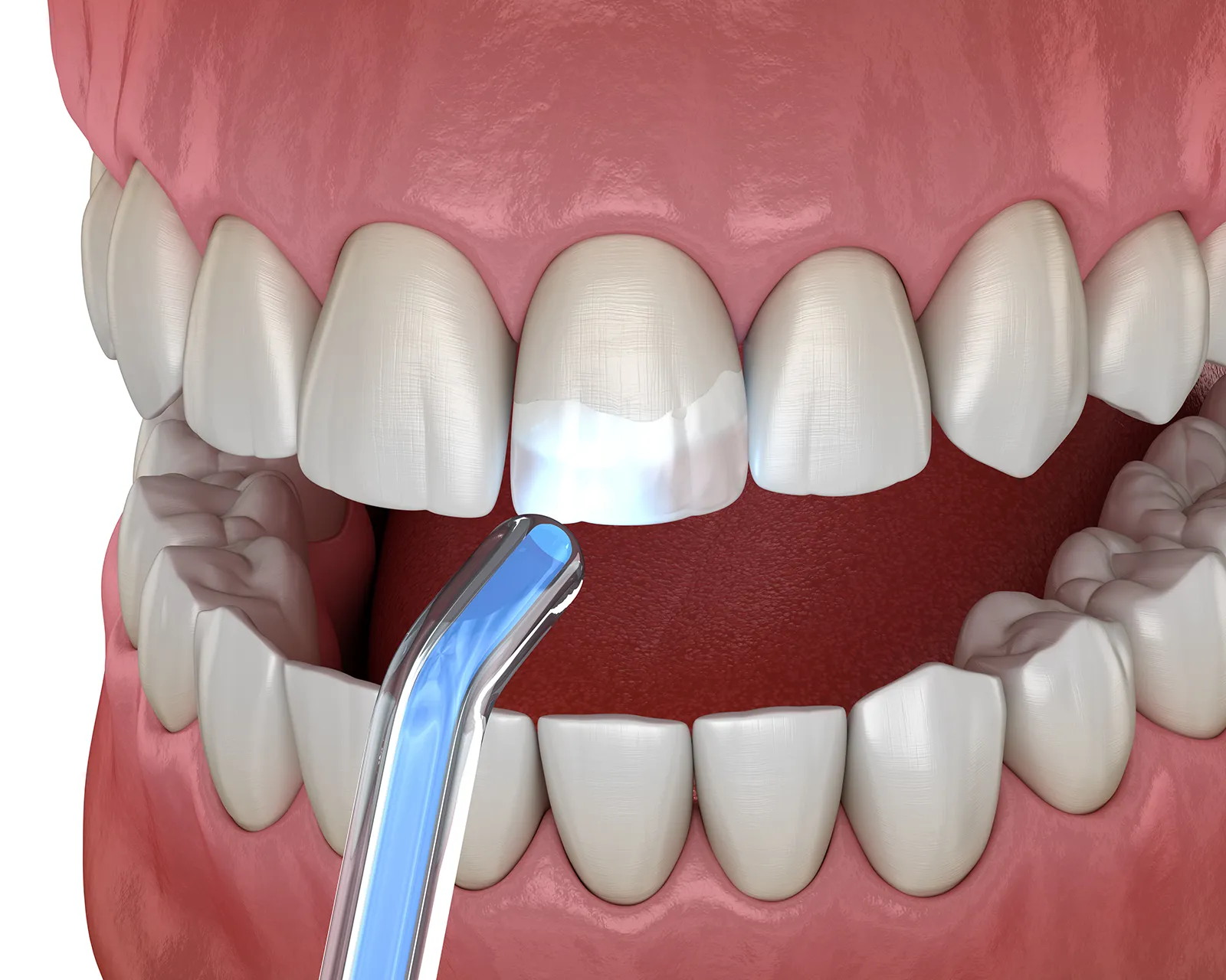 Dr. Crepaz - Leistungen - Whitespots