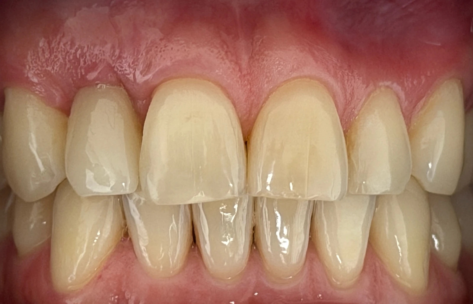 Patientenfoto - Nachher