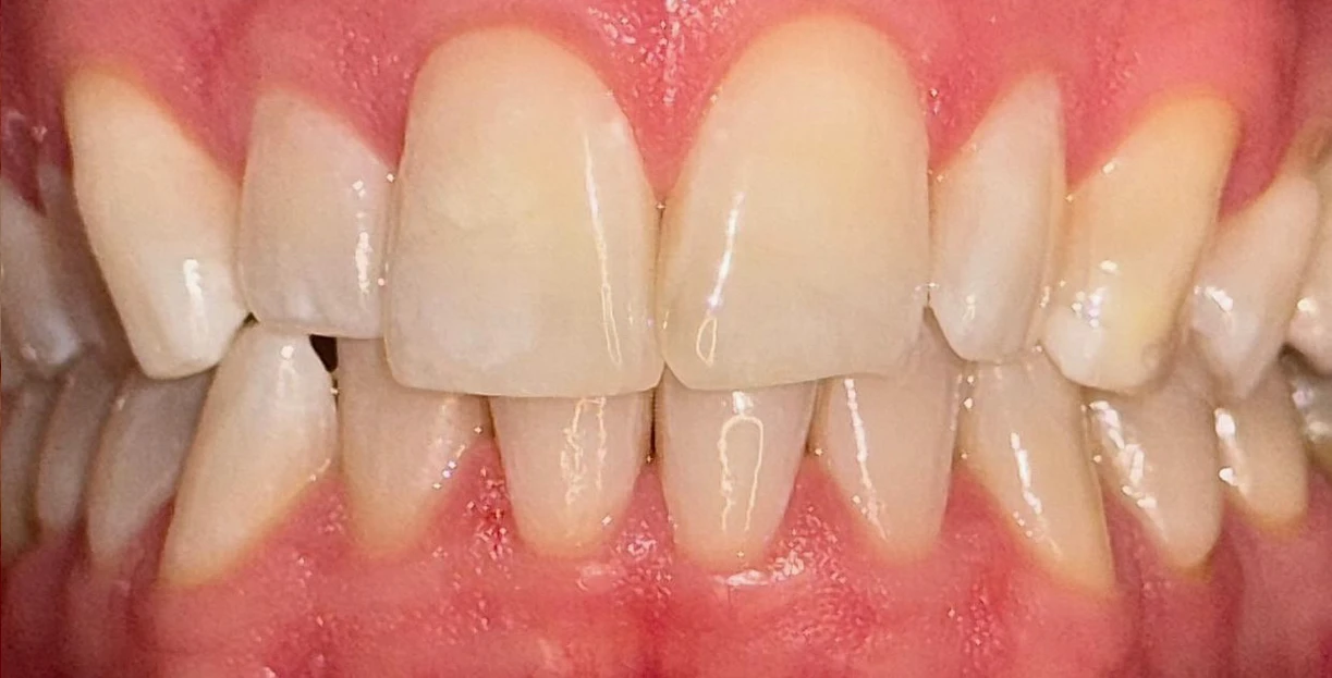 Patientenfoto - NAchher