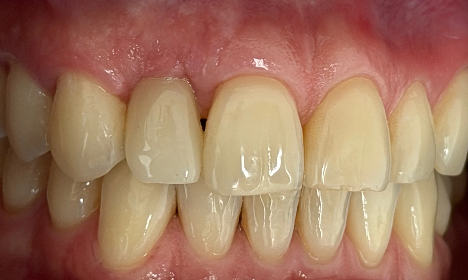 Patientenfoto - Nachher