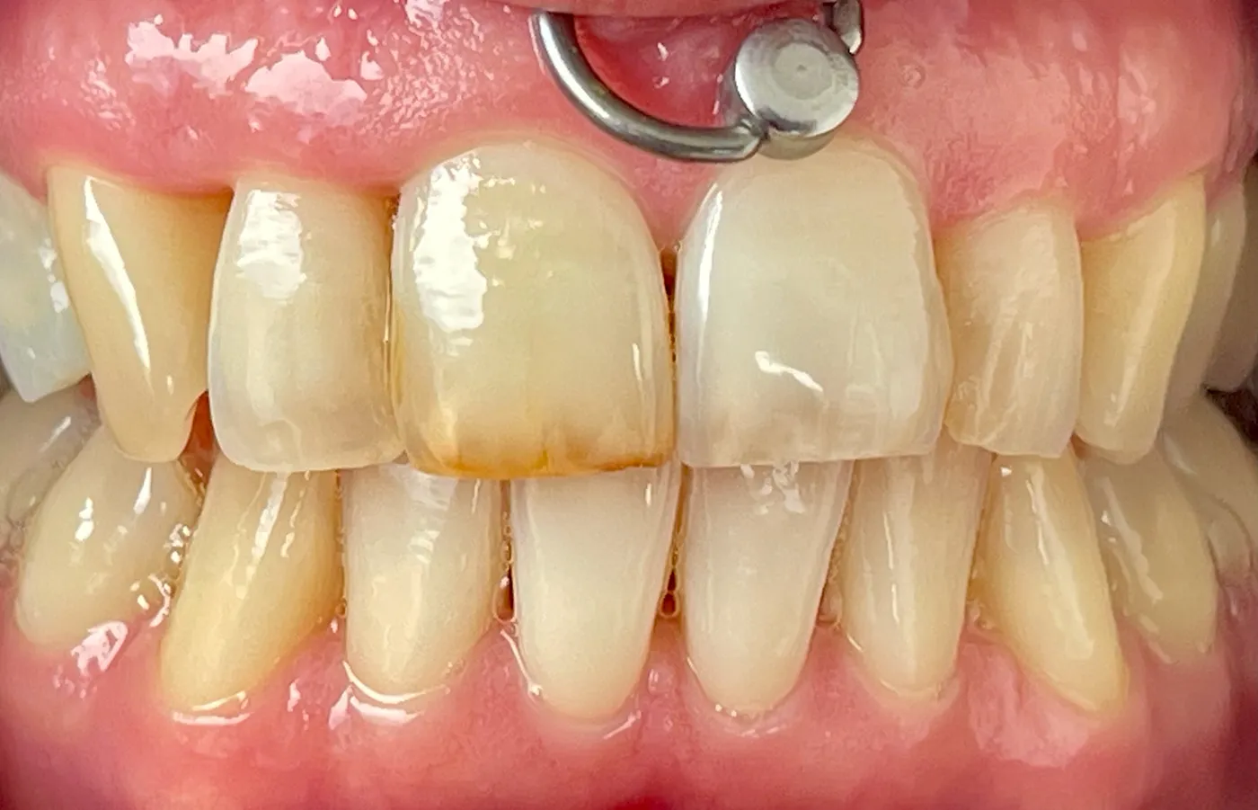 Leistungen - Patientenfoto - Vorher