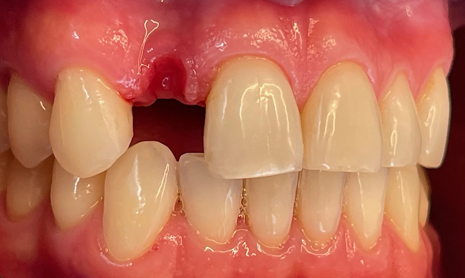 Patientenfoto - Zahn fehlt - Vorher