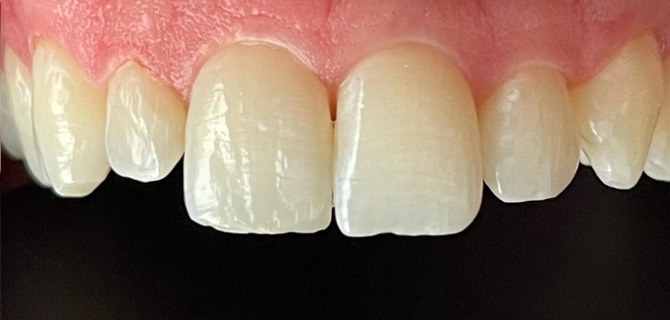 Leistungen - Patientenfoto - Nachher