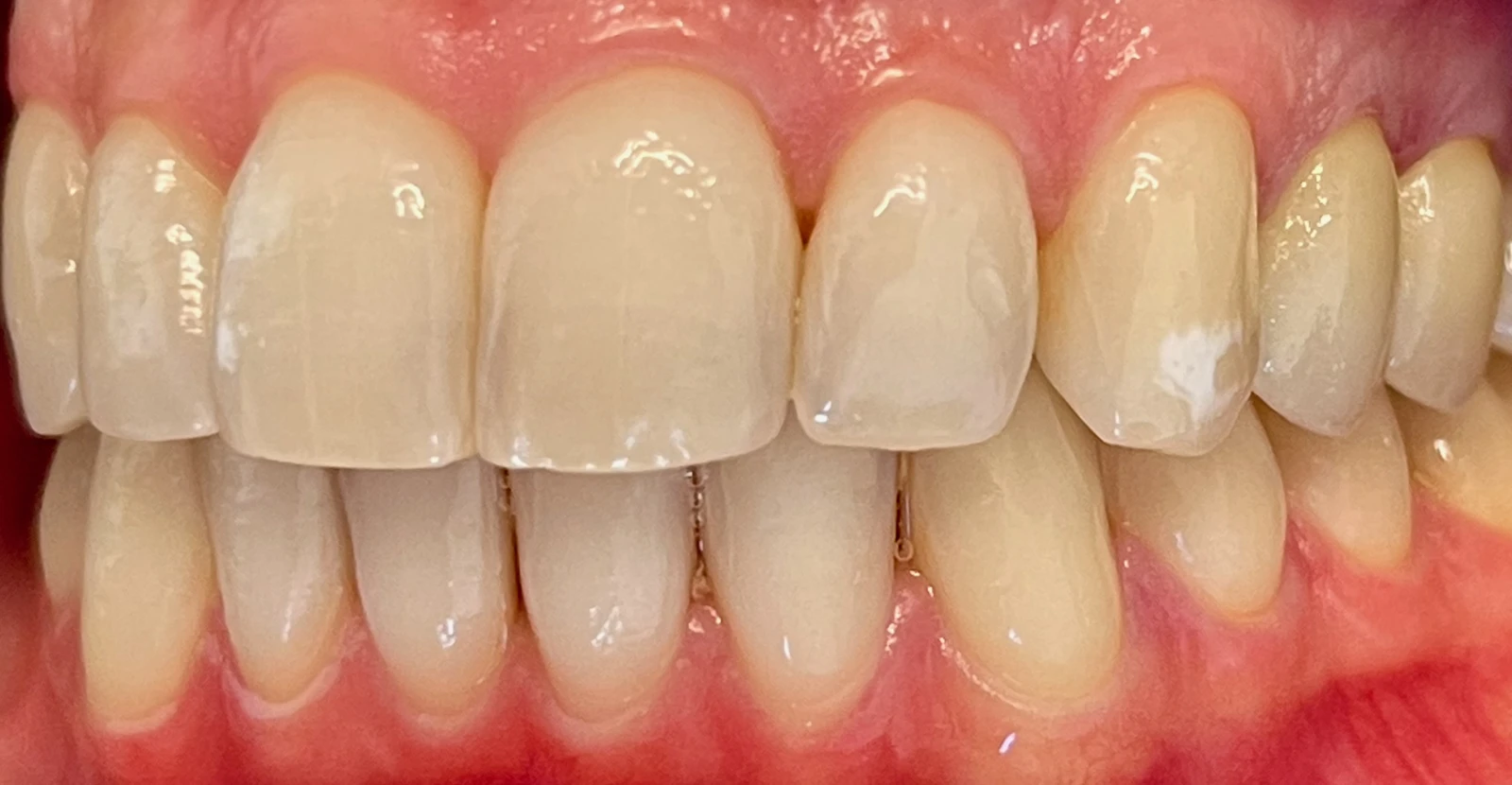 Patientenfoto - Nachher