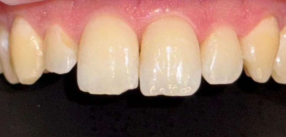 Leistungen - Patientenfoto - Vorher