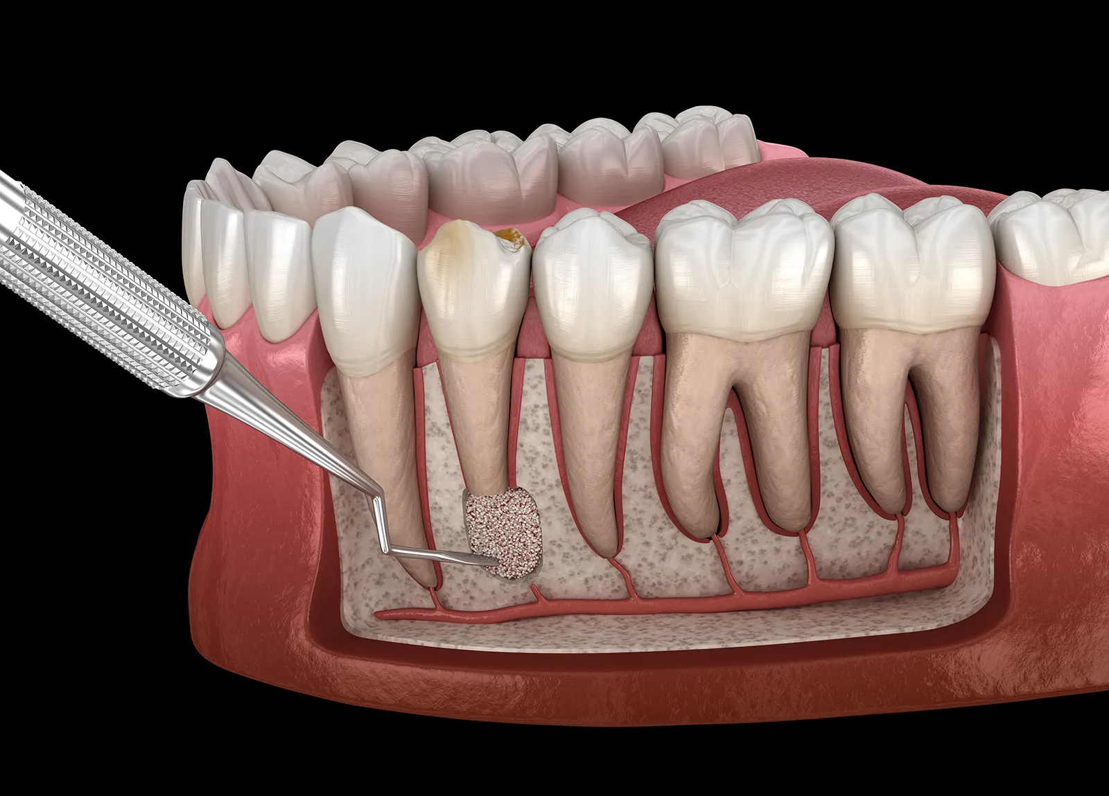 Dr. Crepaz - Leistungen - Wurzelspitzen